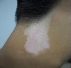 为何提及白癜风会让人大惊失色呢?(图1)