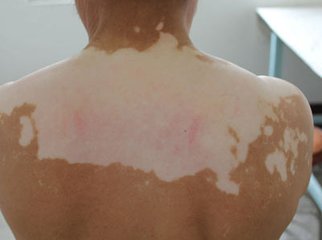马春林介绍白癜风的危害有什么？(图1)