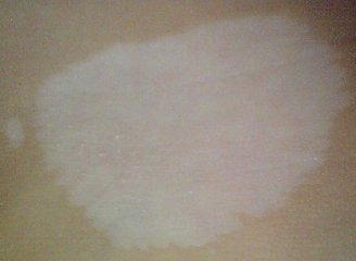 治儿童白斑需要多少钱?(图1)