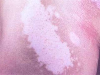 女性白癜风日常怎么做?(图1)