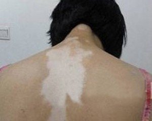 如何护理局限型白癜风患者的皮肤?(图1)