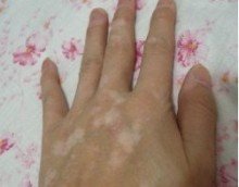 治白癜风得花多少钱?(图1)