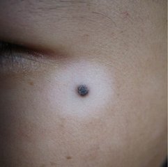 白癜风与机体免疫功会有关系吗?(图1)