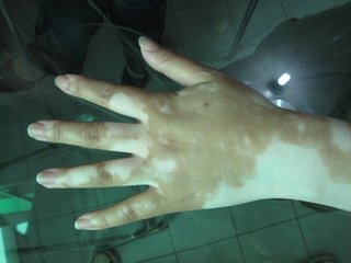 手上有白癜风如何自检呢?(图1)