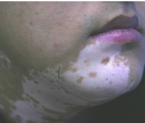 如何治疗节段型白癜风呢?(图1)
