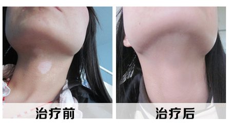 女性白癜风和哪些因素有直接关系？(图1)