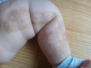 宝宝患上白癜风后怎么办?(图1)