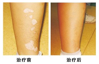 患有白癜风更应注意这些!(图1)