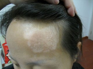面部白癜风对患者的危害?(图1)