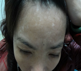常见白癜风危害都有哪些?(图1)
