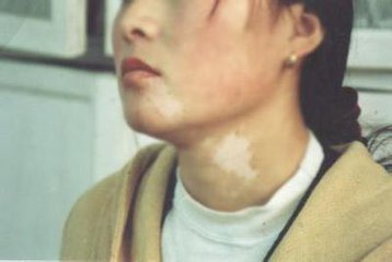 白癜风会危害到哪些方面?(图1)
