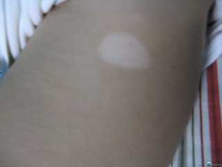 为什么白癜风会感觉到瘙痒?(图1)