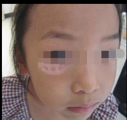 儿童白癜风患者的饮食注意事项?(图1)