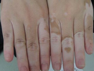手上的白癜风有哪些危害?(图1)