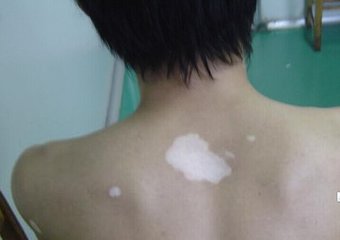 如何治疗发展时期的白癜风?(图1)