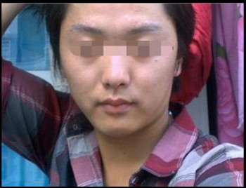白癜风是怎样引起的?(图1)