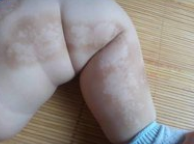 怎样确定小孩是不是得了白癜风