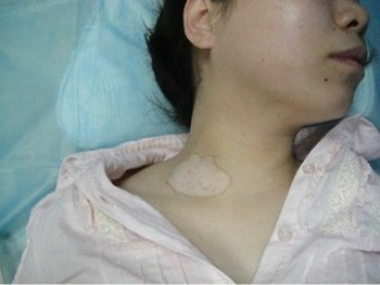得了白癜风在生活中应该注意什么？(图1)