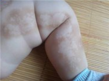 白癜风初期有什么样的状况