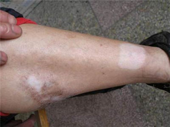 女性患了白癜风怎样治疗