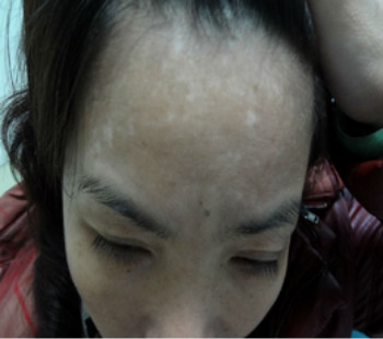 白癜风患者在忌口方面应注意什么?(图1)