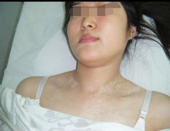 女性患了白癜风应该怎样治疗?(图1)
