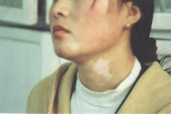 白癜风患者可以给孩子喂母乳吗？(图1)