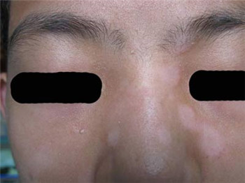 白癜风如果扩散应怎样治疗