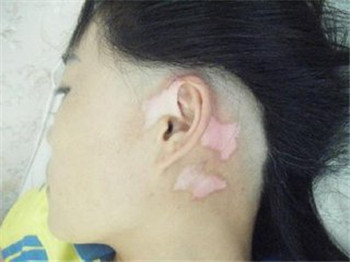 女性白癜风应该怎样治疗