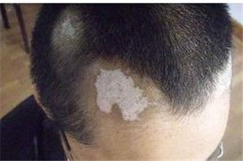 大人预防白癜风该怎么做