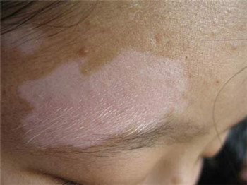 白癜风不同时期各有怎样的症状表现?(图1)