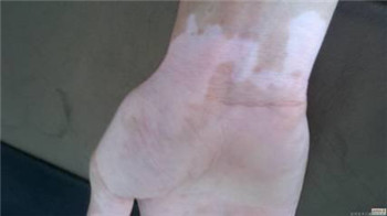 白癜风的症状都是什么样的？(图1)