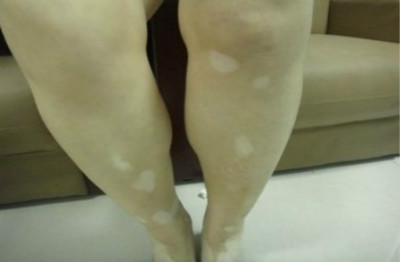 白癜风不同阶段的症状是什么样的？(图1)