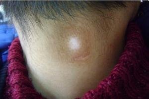常见的白癜风有哪些症状?(图1)
