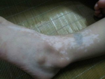 患者在白癜风治疗中有哪些注意的？(图1)