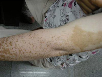 白癜风患者发病了有什么症状?(图1)