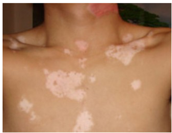 患上白癜风可以喂孩子母乳