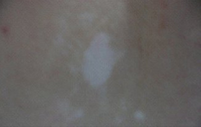 白癜风患者怎么进行保养