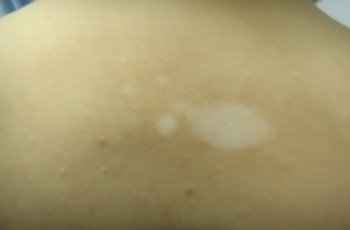 白癜风这个病是不是治不好的