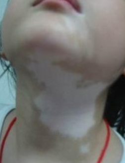 泛发型白癜风有什么特点呢