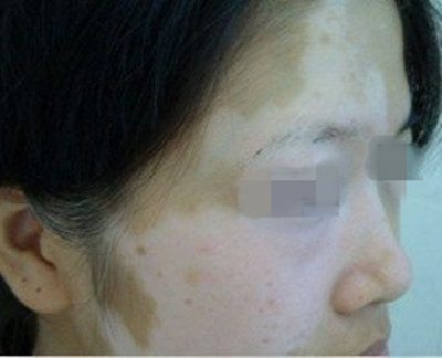女性白癜风怎么治疗呢