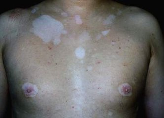 怎么预防节段型白癜风