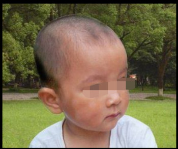 有什么好的方法预防儿童患上白癜风