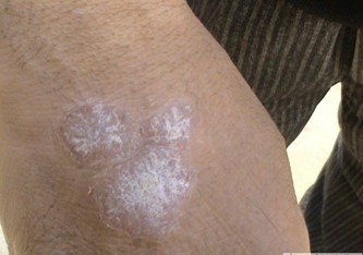 怎么治疗白癜风病比较好