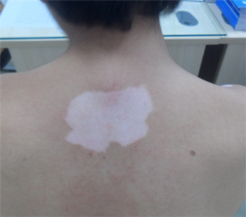 女性患上了白癜风到底怎样治疗