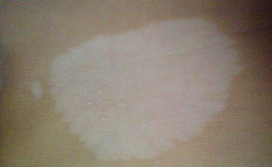 白癜风在早期治疗时要注意什么事项