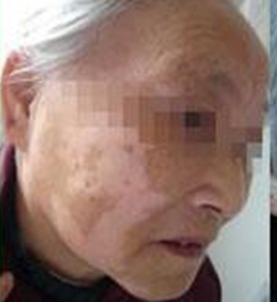中老年人患上白癜风会造成哪些影响