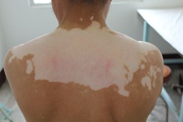 得了白癜风后有什么明显症状